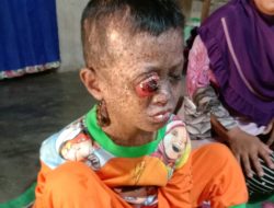 Alami Penyakit Langka, Bocah 5 Tahun Muhammad Makruf Fadholi Menjadi Perhatian Banyak Pihak